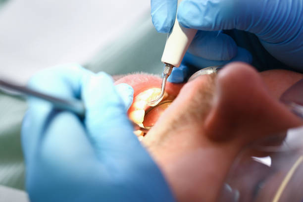 Best Emergency Wisdom Tooth Extraction in Lake Erie Beach, NY